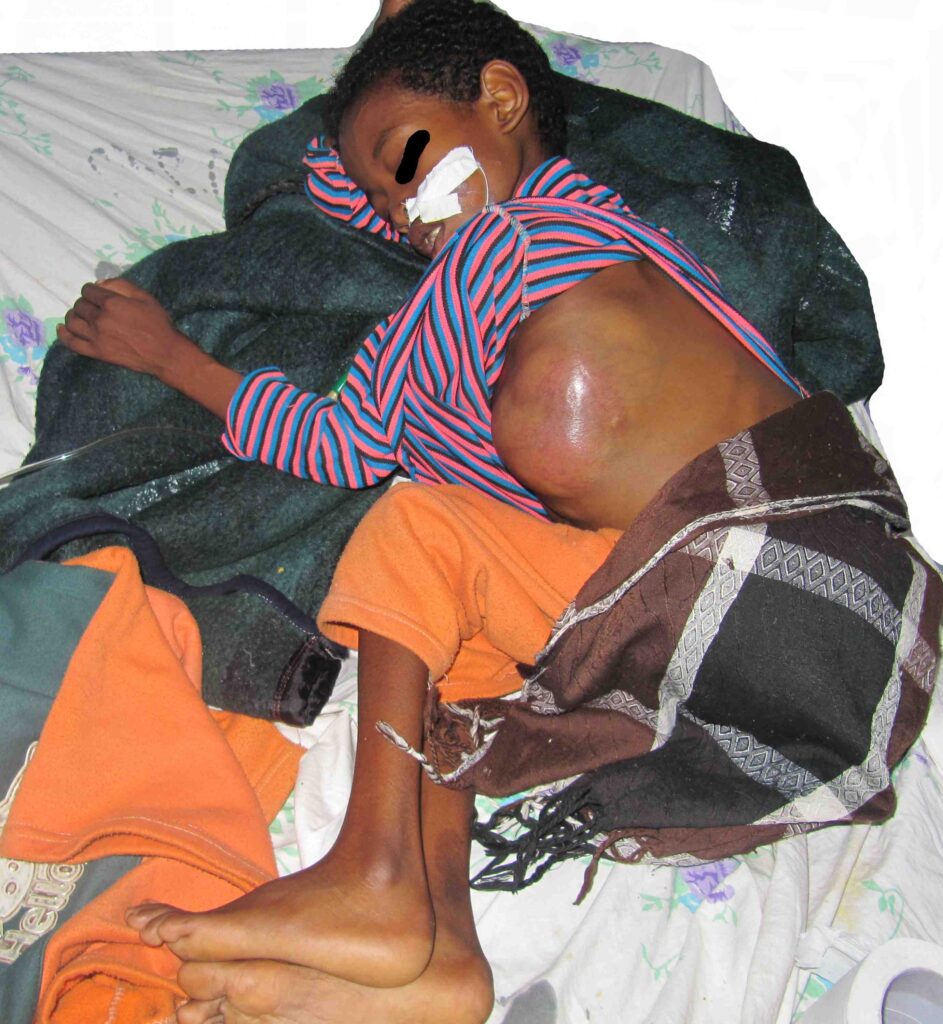 Giant neuroblastoma in an Ethiopian shepherd child